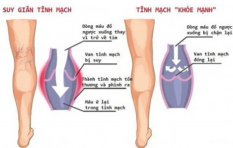 Tại sao suy giãn tĩnh mạch không được ngâm chân nước nóng?