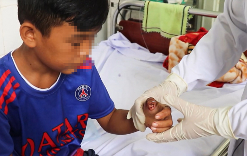 Liên tiếp các trường hợp trẻ bị tai nạn sinh hoạt đứt lìa tay