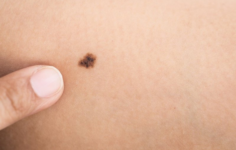 Nhiều lần bắn nốt ruồi ở nước ngoài, về Việt Nam mới phát hiện ung thư da