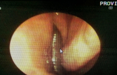 Phát hiện đỉa rừng dài 4cm trong mũi bé gái 9 tuổi