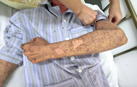 Dính silicon trong lúc sửa nhà, người đàn ông bị kích ứng toàn thân, mù tạm thời, suy gan thận