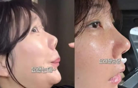 Cứ 4 phụ nữ trẻ Hàn Quốc thì có 1 người đã phẫu thuật thẩm mỹ