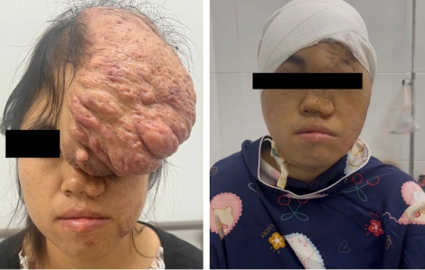 Trả lại khuôn mặt cho cô gái sau 15 năm chịu đựng khối u khổng lồ