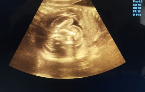 Em bé ở Ấn Độ chào đời với 2 bào thai trong bụng