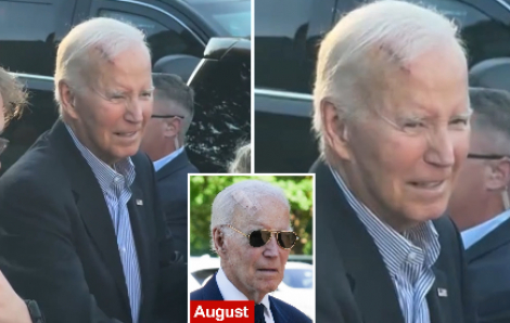 Cựu tổng thống Mỹ Joe Biden vừa phẫu thuật ung thư da