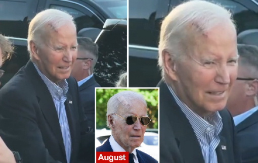 Cựu tổng thống Mỹ Joe Biden vừa phẫu thuật ung thư da Cựu tổng thống Mỹ Joe Biden vừa phẫu thuật ung thư da