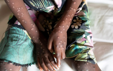 WHO dỡ bỏ tình trạng khẩn cấp toàn cầu đối với bệnh đậu mùa khỉ