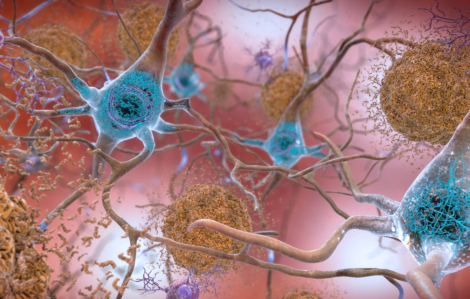 Nhật Bản đạt được đột phá trong nghiên cứu điều trị bệnh Alzheimer