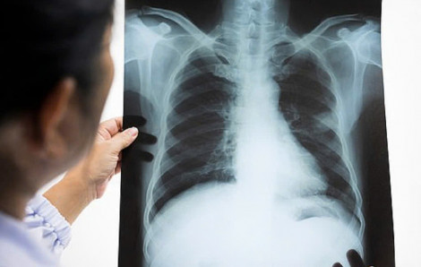 Mỗi năm có khoảng 180.000 người mắc ung thư mới