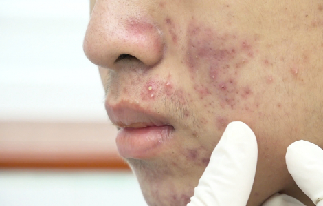 Trẻ 'lén' trang điểm gây nhiều tổn thương cho da