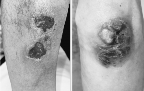 Trợt loét, hoại tử da vì uống thuốc sai liều