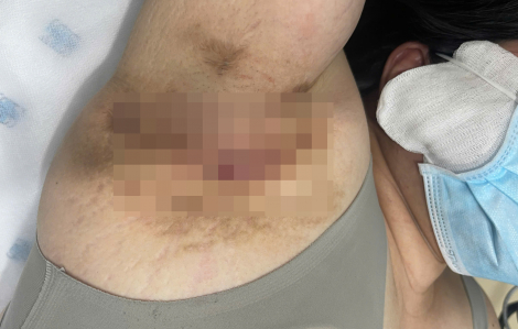 Chấm dứt 9 năm u tuyến mồ hôi mưng mủ nhờ phương pháp điều trị đột phá