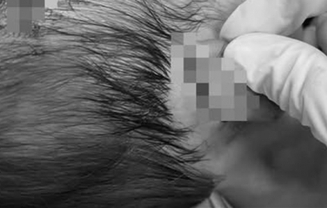 Chó dữ cắn vào vùng mặt, đầu, bé gái 19 tháng tuổi bị thương nặng