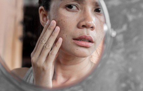 7 thói quen vô tình “nuôi dưỡng” nám