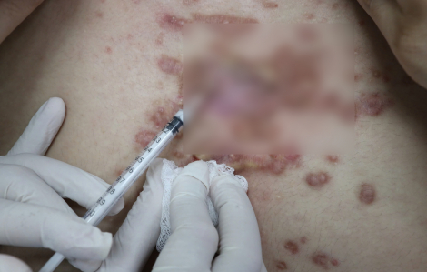 Tiêm chất làm đầy, người phụ nữ bị áp xe cả vùng đùi, mông