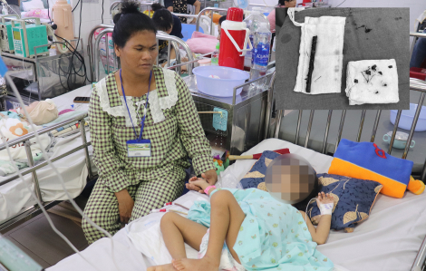 Phẫu thuật lấy đoạn cây 16cm nằm trong bụng bé gái suốt 4 tháng