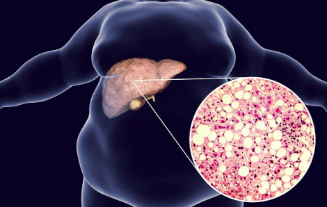 Người trẻ mắc gan nhiễm mỡ có nguy cơ ung thư sớm cao hơn 20%