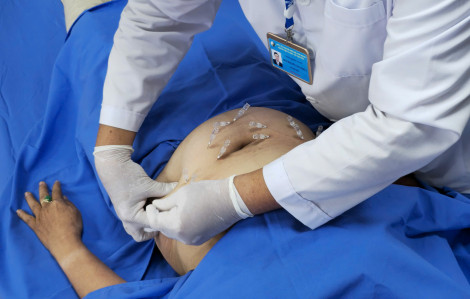 Cấy chỉ có làm xơ mạch máu không?