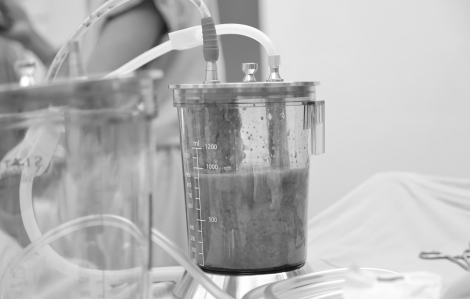 Nhiều bệnh nhân bị biến chứng sau khi tiêm tan mỡ