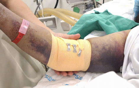 Sau mưa bão, nhiều bệnh nhân sốc, nguy kịch do sốt xuất huyết