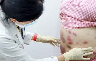 Tai biến do hút mỡ, làm sao để tìm cơ sở an toàn?