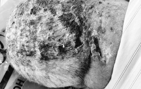 Cụ ông liên tục co giật, la hét vì đau đớn sau đắp lá chữa “giời leo”