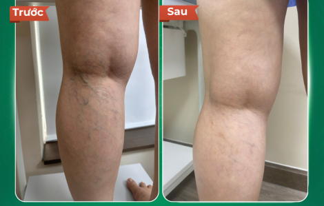 Phác đồ điều trị suy giãn tĩnh mạch chi dưới tại Dr.Vein