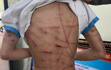 Bé gái bị in dấu đòn roi chằng chịt khắp người, nghi bị cha dượng đánh