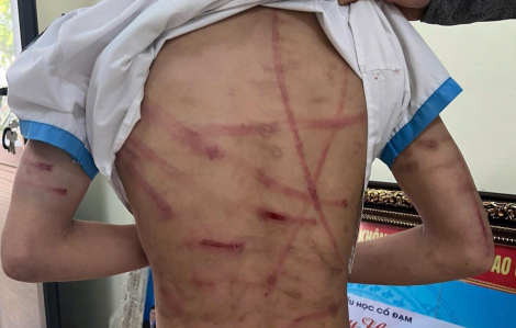 Bắt khẩn cấp cha dượng bạo hành con gái của vợ