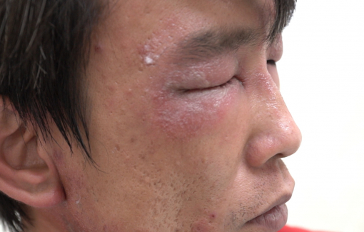 Nhiều người viêm da nặng do loại côn trùng có độc tố cao