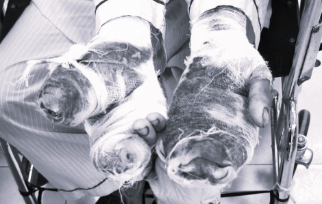 Người phụ nữ nát 2 bàn tay vì chó nhà tấn công