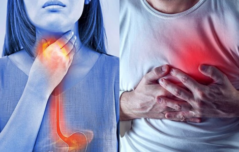 Trào ngược dạ dày làm tăng nguy cơ đau tim