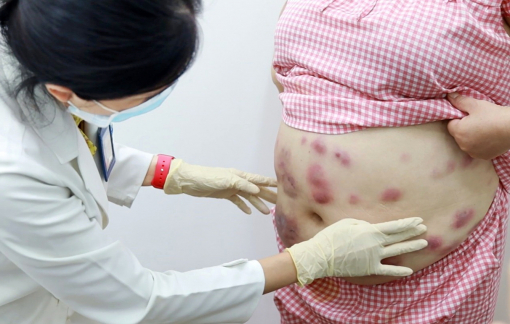 Tai biến do hút mỡ, làm sao để tìm cơ sở an toàn?