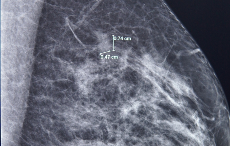 Bệnh nhân 61 tuổi "thoát án tử” ung thư vú nhờ “đi khám cho yên tâm”