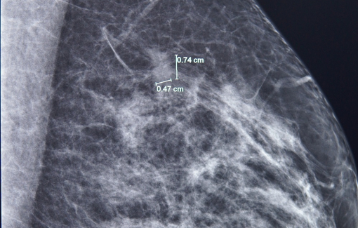 Bệnh nhân 61 tuổi "thoát án tử” ung thư vú nhờ “đi khám cho yên tâm”