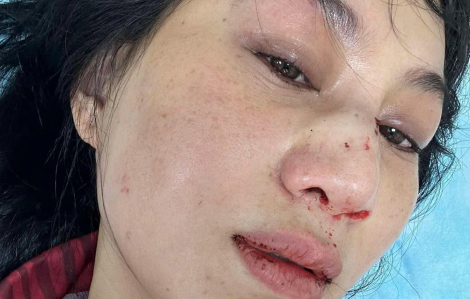 Diễn viên võ thuật Phi Ngọc Ánh bị chồng cũ đánh: Chịu đòn để đòi công lý?