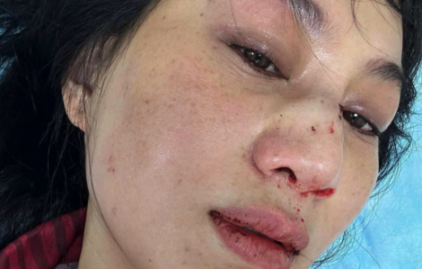 Sốc trước lời kêu cứu của diễn viên Phi Ngọc Ánh khi bị chồng cũ đánh liên tục