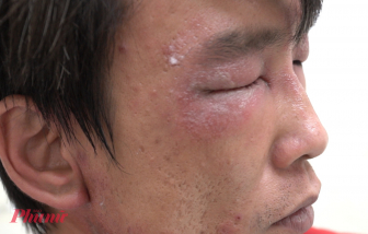 Nhiều người viêm da nặng do loại côn trùng có độc tố cao