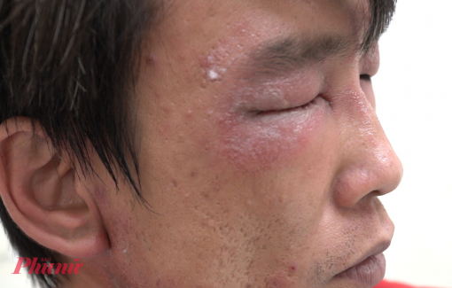 Nhiều người viêm da nặng do loại côn trùng có độc tố cao