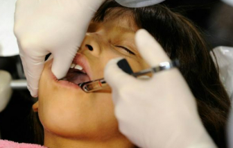 Nhiều nước loại bỏ việc trám răng chứa thủy ngân từ năm 2034