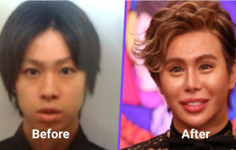 Bị bắt nạt từ bé, chàng trai Nhật Bản trải qua 200 đợt phẫu thuật để thay đổi ngoại hình