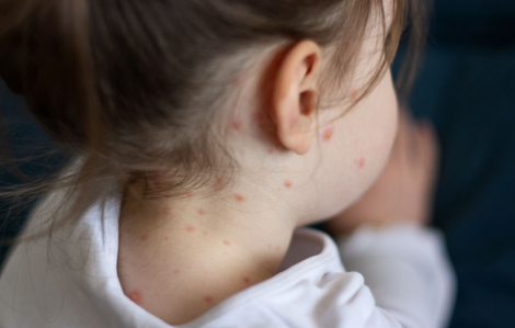 WHO: Bệnh sởi đã trở lại trên toàn cầu