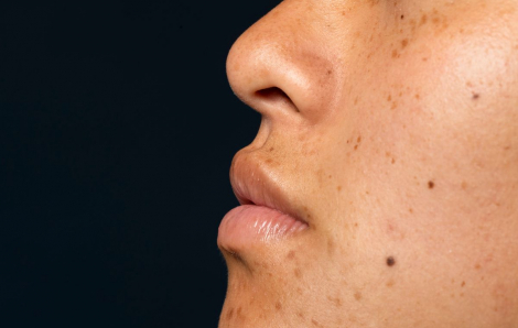 Tại sao mụn không nặn vẫn để lại vết thâm?