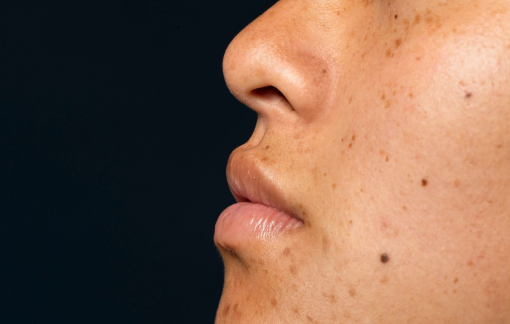 Tại sao mụn không nặn vẫn để lại vết thâm?