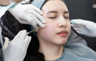 Những hệ lụy từ việc tiêm filler mà có thể bạn chưa biết