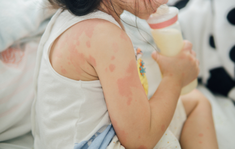 Có thể phân biệt trẻ nổi ban do dị ứng hay nhiễm siêu vi?