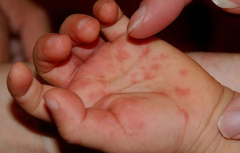Tay chân miệng diễn biến phức tạp, bác sĩ chỉ nguyên nhân không thể chủ quan