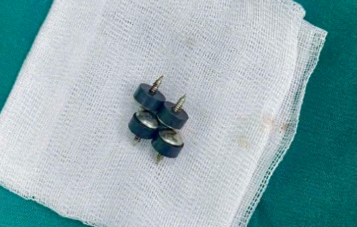 4 viên đinh nam châm từ đồ chơi bám chặt trong đường tiêu hóa bé 2 tuổi