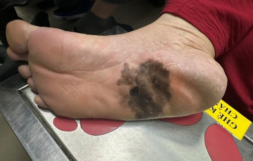 Gần chục năm xuất hiện đốm đen ở gan bàn chân, người phụ nữ phát hiện ung thư