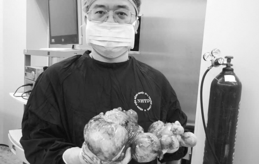 Bác sĩ kinh ngạc vì khối u buồng trứng khổng lồ của thiếu nữ 20 tuổi